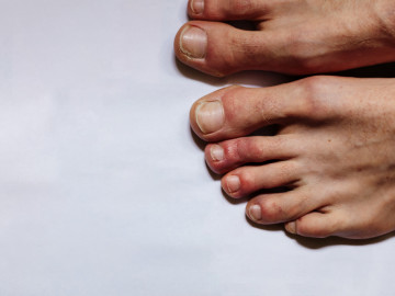 Nackte Füße mit frostbeulenähnlichen Hautveränderungen