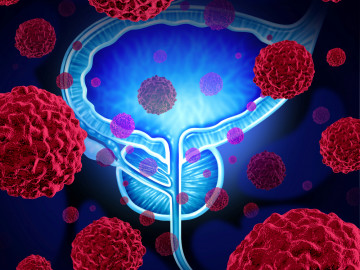 Schematische Darstellung einer von mit Krebszellen befallenen Prostata.