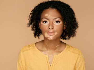 Frau afrikanischer Herkunft mit Vitiligo. Die Haut im Gesicht ist teilweise entfärbt.