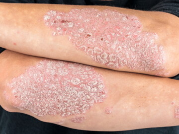 Psoriasis an den Armen