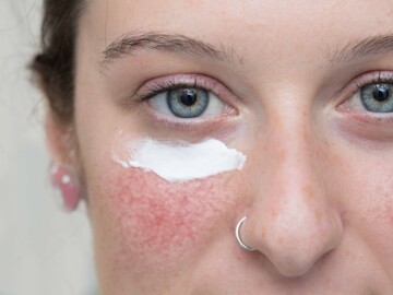 Frau mit Rosacea und Creme im Gesicht