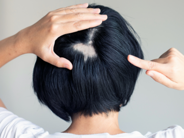 Hinterkopf einer Frau mit Haarausfall