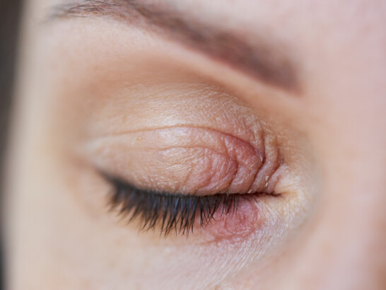 Schuppen an den Wimpern  vielleicht sind es Milben | DAS PTA MAGAZIN